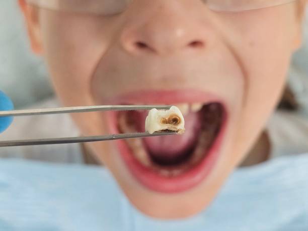 Best Emergency Wisdom Teeth Removal in Pleasure Point, CA